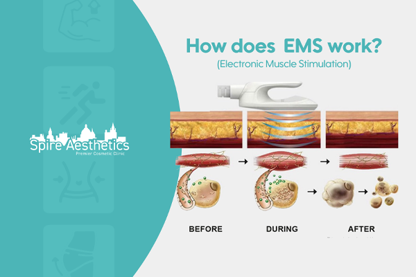 EMS treatment for post pregnancy weight loss treatment Gainsborough