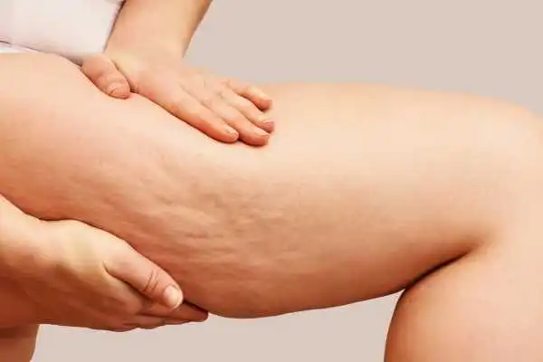 Image of woman showing leg with cellulite Gainsborough