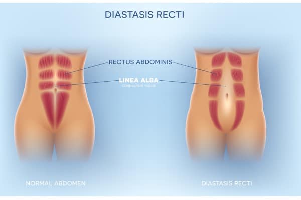 What Non-Surgical Options Are Available for Diastasis Recti Gainsborough?