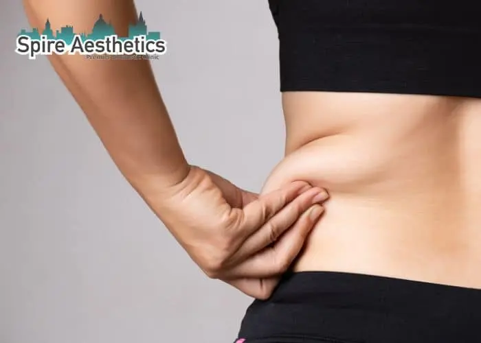 Image of woman pinching fat on their hips Gainsborough. Fat Freezing treatment