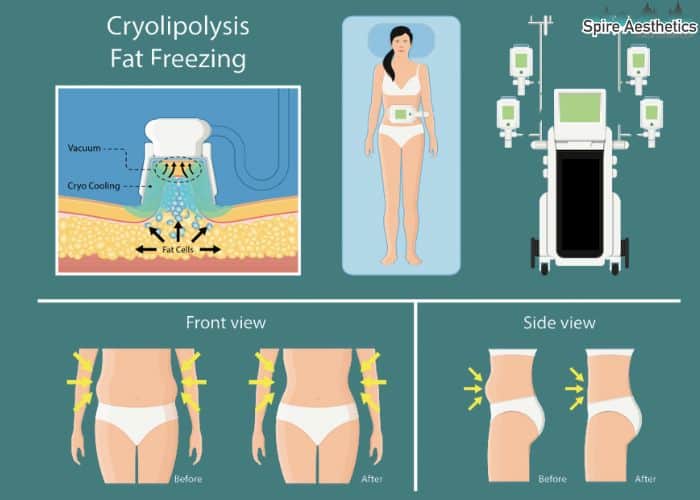 Image of diet and fat freezing combined for best results for Spire Aesthetics Gainsborough