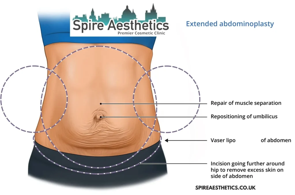 Understanding Loose Skin After Gastric Band Gainsborough Surgery and HIFU Treatment
