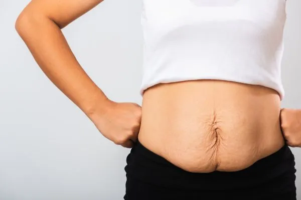 Image of a woman's stomach after weight loss with sagging skin following a gastric band Gainsborough