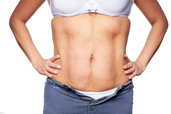sagging skin on woman's stomach after weight loss injections Gainsborough