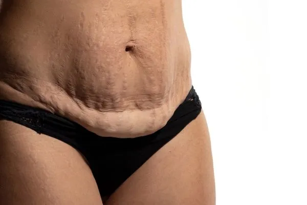 Image of womans stomach after weight loss injections Gainsborough showing saggy skin