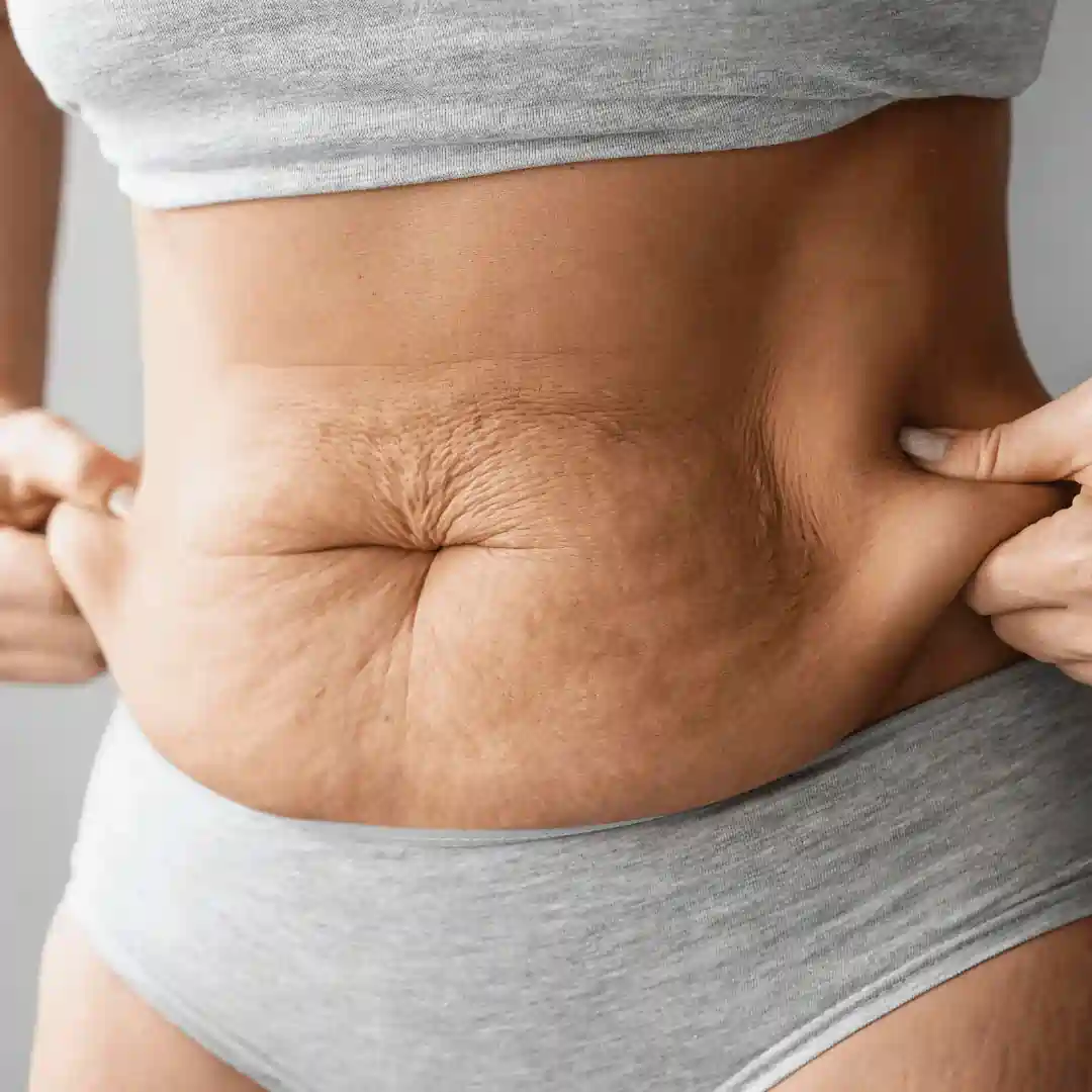 Is It Normal to Have Loose Skin After Pregnancy Gainsborough?