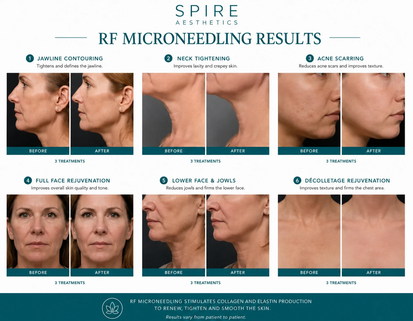 RF Microneedling Skin tightening Gainsborough results