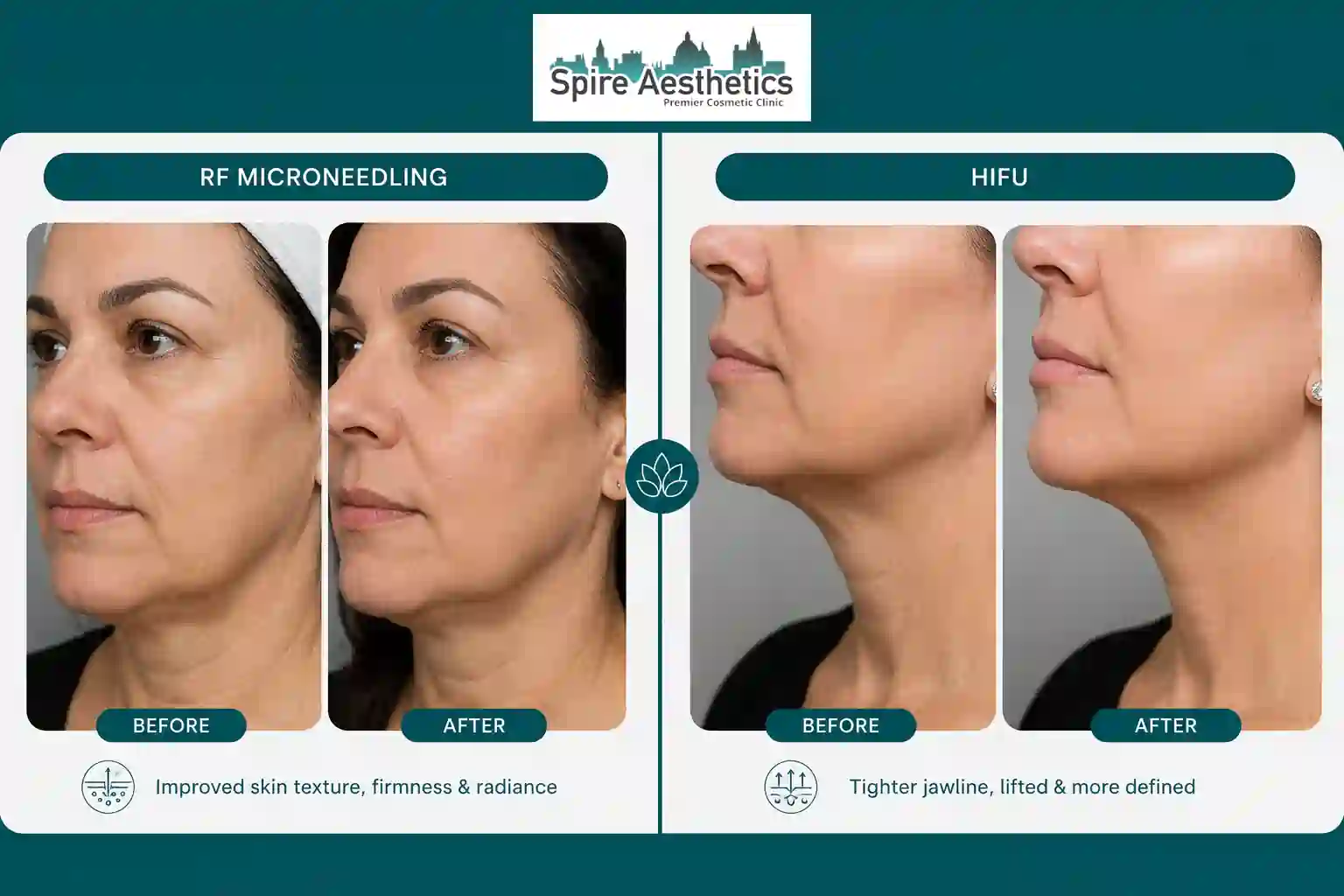Can RF Microneedling and HIFU Be Combined Gainsborough?