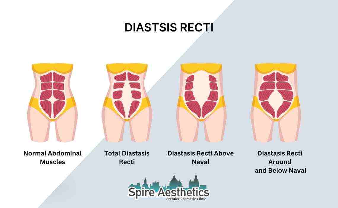 Is Non-Surgical Diastasis Recti Treatment Right for You? Common Concerns Answered Gainsborough